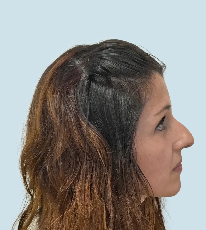 Rinoplastia Barcelona - Antes