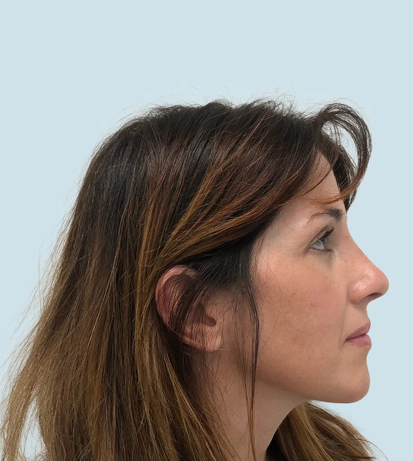 Rinoplastia Barcelona - después