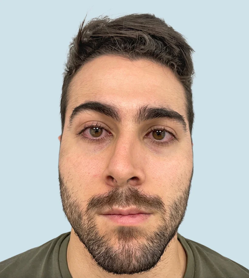 Rinoplastia Barcelona - Antes