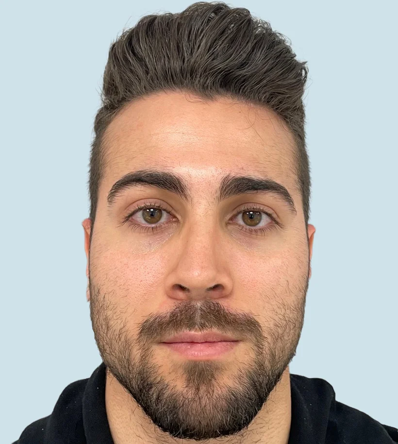 Rinoplastia Barcelona - Después