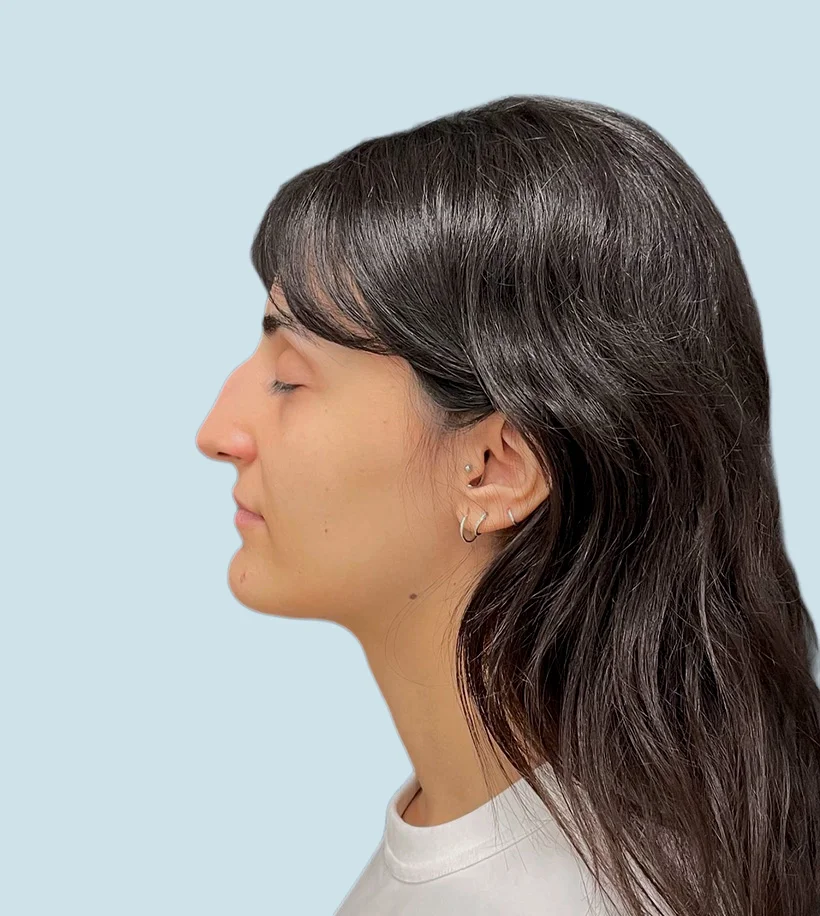 Rinoplastia Barcelona - Antes