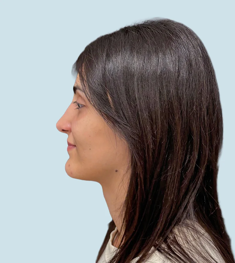 Rinoplastia Barcelona - Después