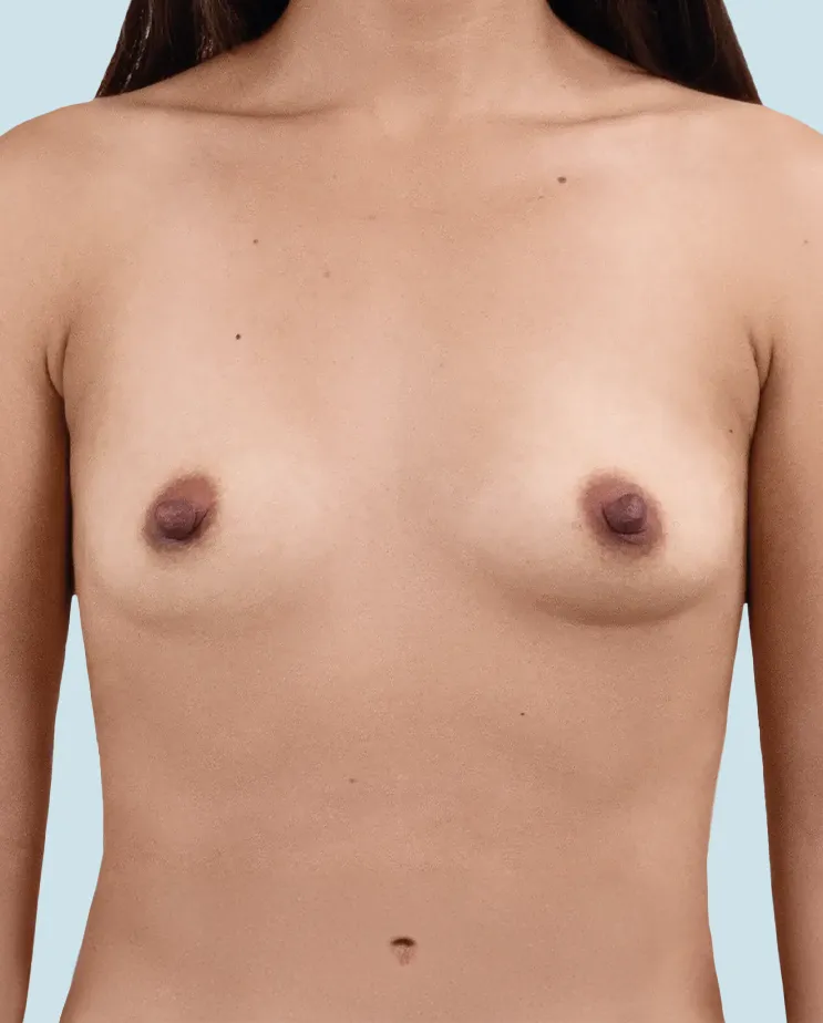 Antes del Aumento de pecho Mia Femtech