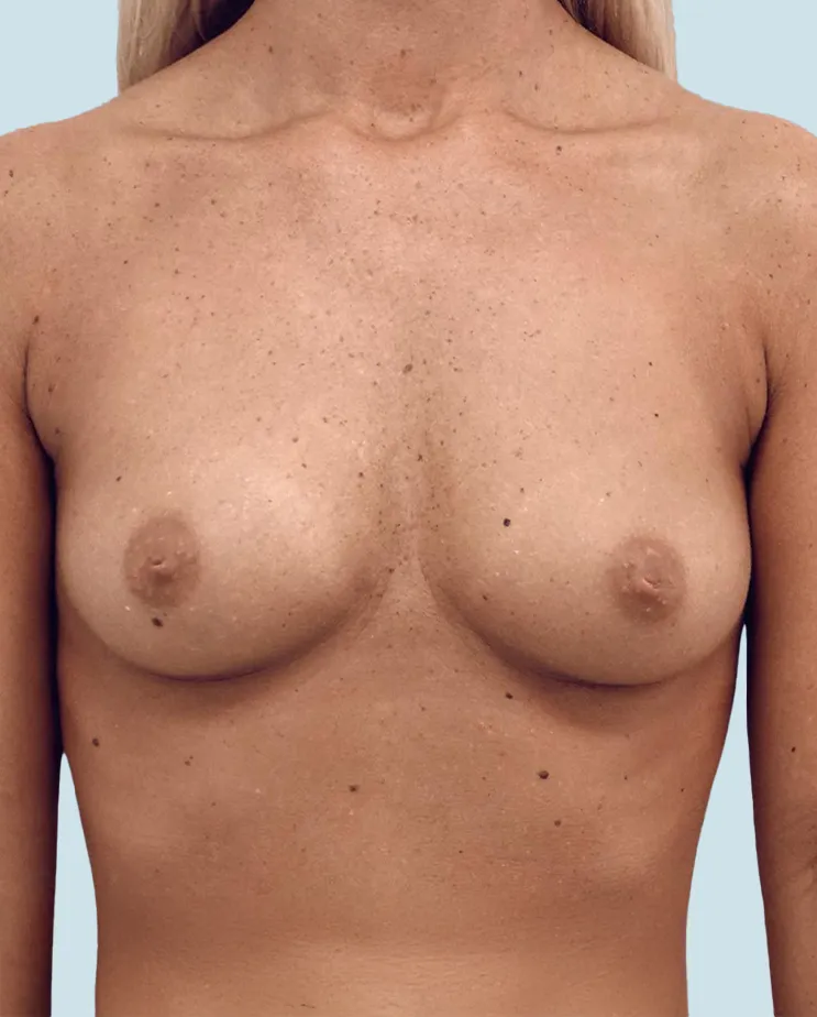 Antes del Aumento de pecho Mia Femtech