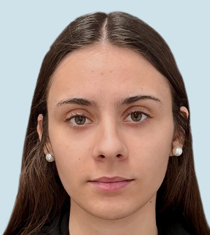 rinoplastia y después Barcelona