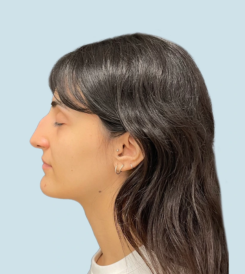 Rinoplastia Barcelona antes y después