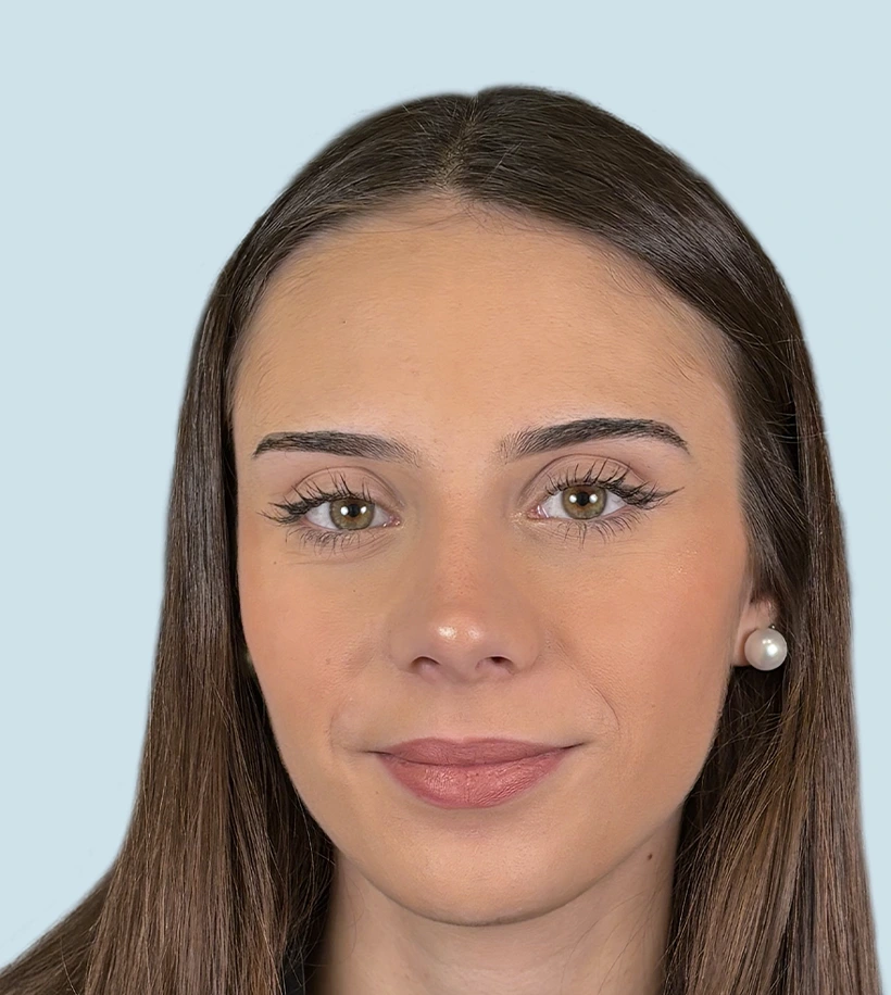 rinoplastia y después Barcelona