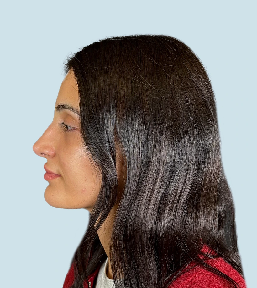 Rinoplastia Barcelona antes y después